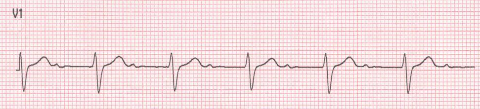 Intervallo PR o PQ 35 Misura: dall inizio dell onda P all inizio del complesso QRS Cos è? : conduzione attraverso gli atri + conduzione attraverso AV Varia?