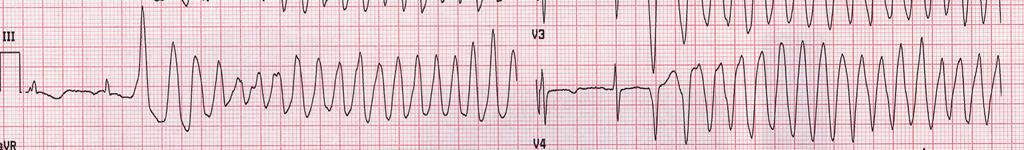 QT lungo 38 Il QT lungo espone al rischio di Torsione di punta indotta da un extrasistole ventricolare con il meccanismo dell onda R su onda T.