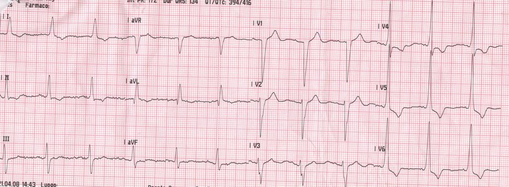 Ipertrofia ventricolare sinistra aspetto ECGrafico 42 Produce complessi QRS molto evidenti sia in altezza che in profondità,