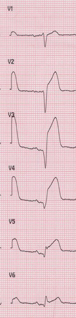 condizioni normali (ripolarizzazione