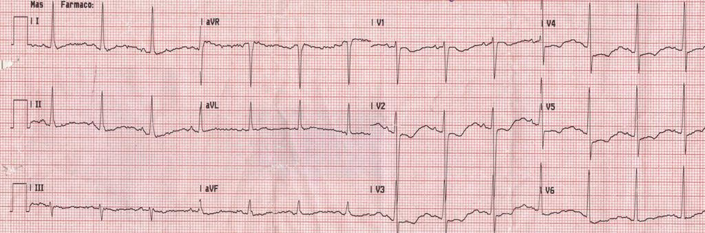 Ipokaliemia 63 1