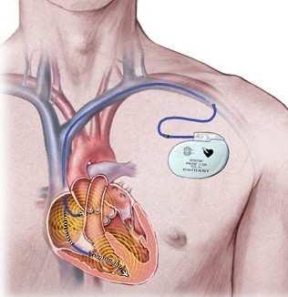 I pacemaker Il PM viene alloggiato in una tasca sottocutanea confezionata chirurgicamente in sede