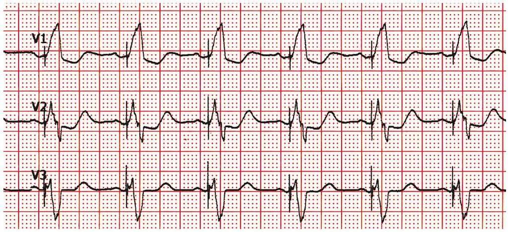 L elettrocardiogramma stimolato Quando si impiega un sistema di stimolazione unipolare, la notevole