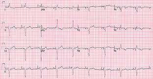 L elettrocardiogramma stimolato Quando si impiega un sistema di stmolazione bipolare il campo elettrico è circoscritto, a causa della breve distanza