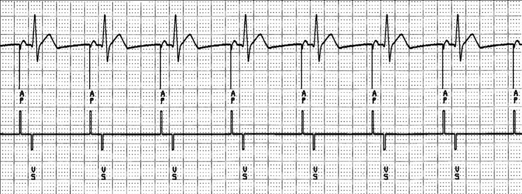L elettrocardiogramma stimolato la conduzione atrio-ventricolare spontanea è più rapida di quella programmata (ossia l intervallo tra l attività atriale, spontanea o stimolata