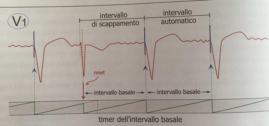 Intervalli di stimolazione Parametro dominante nella gerarchia funzionale dei PM è l intervallo basale Ciclo della più bassa frequenza di