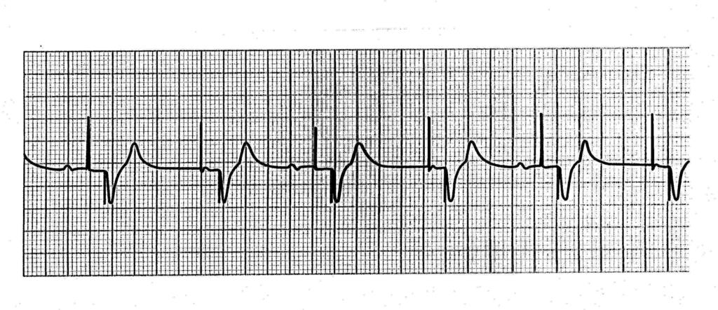 UNDERSENSING