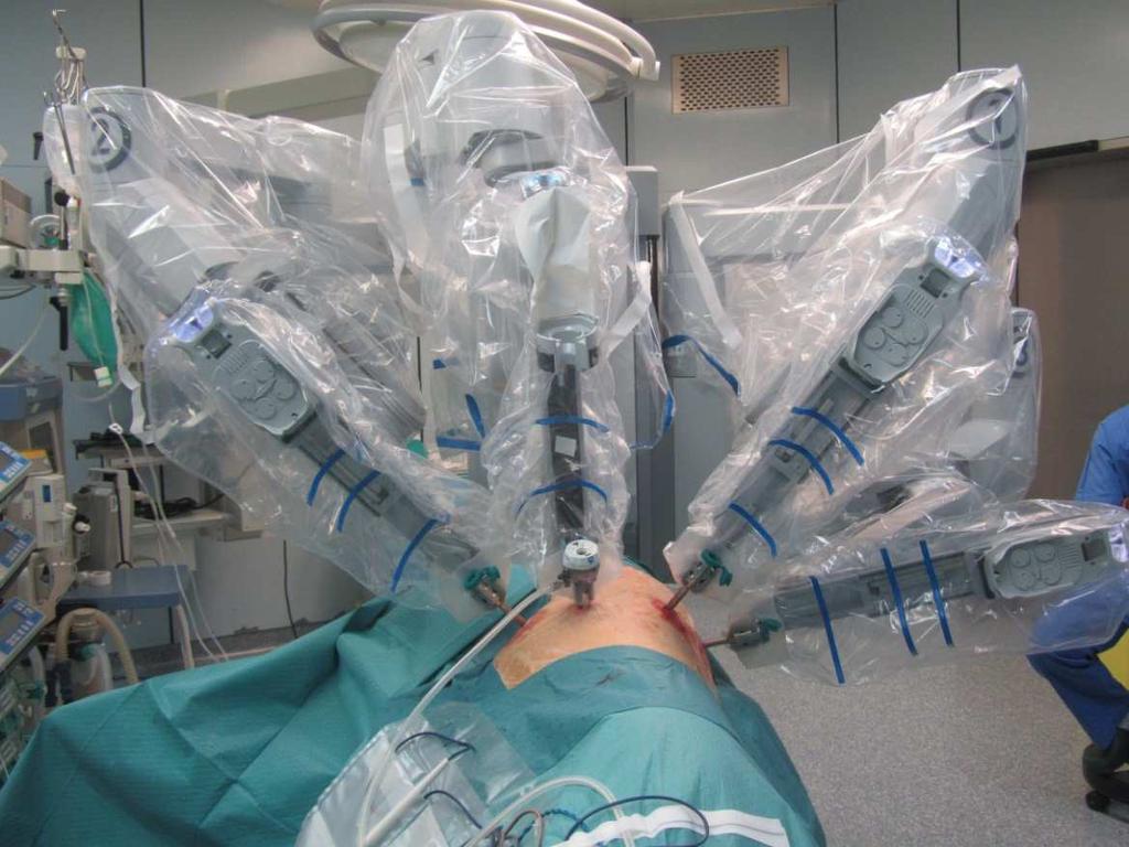 Figura 7. Posizione del paziente e dei bracci robotici durante l intervento di lobectomia polmonare.