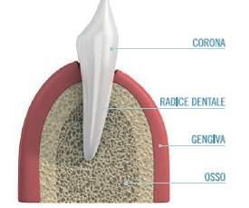 Che cos è un impianto dentale Un dente naturale è costituito da una corona dentale e da una radice La corona rappresenta la parte visibile del dente mentre la radice è immersa nell osso e conferisce