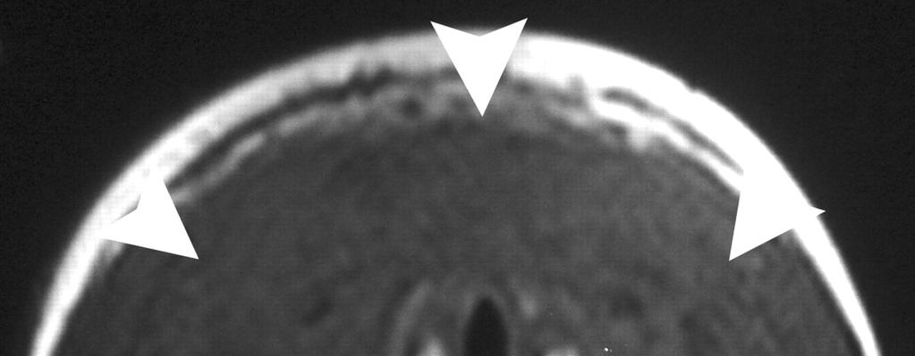 20x In un'altra parte del campione è visibile un gruppo coeso di cellule di Hürthle con citoplasma granulare.