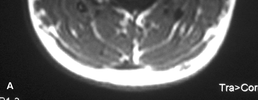 La malattia si risolve una volta che è stata rimossa la ghiandola con relativa fibrosi.