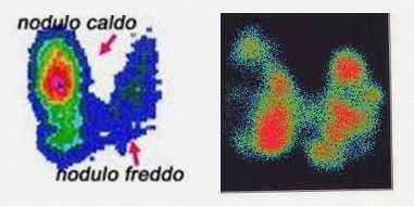 Ecografia Individuazione e caratterizzazione dei noduli Con la tecnica color-doppler è possibile ottenere informazioni sulla vascolarizzazione (e quindi l attività) dei noduli Scintigrafia con