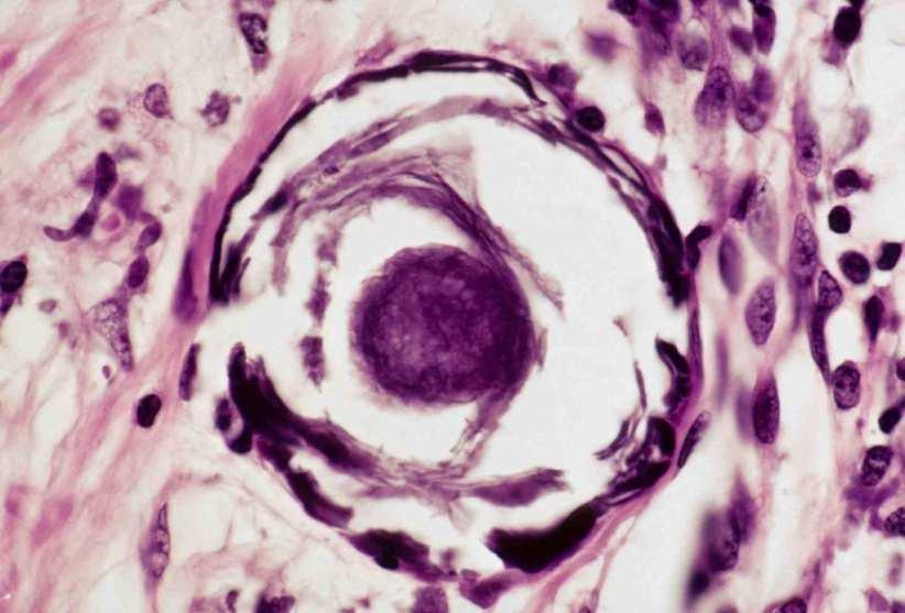 Carcinoma papillare Aspetti istologici Mentre le pseudoinclusioni e le incisure nucleari sono alterazioni costanti, la chiarificazione nucleare è un artefatto presente solo nelle inclusioni in