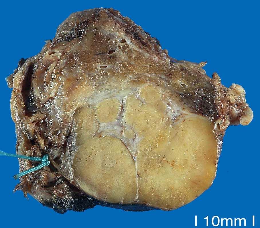 Carcinoma follicolare ampiamente invasivo Marcata invasione vascolare con infiltrazione dei tessuti tiroidei adiacenti.