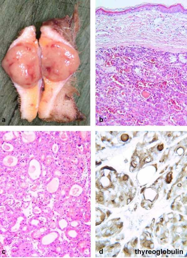 Carcinoma follicolare Comportamento clinico Scarsa tendenza ad invadere i linfatici (a differenza del carcinoma papillare) Più frequente l invasione vascolare ematogena, con metastasi a ossa, fegato,