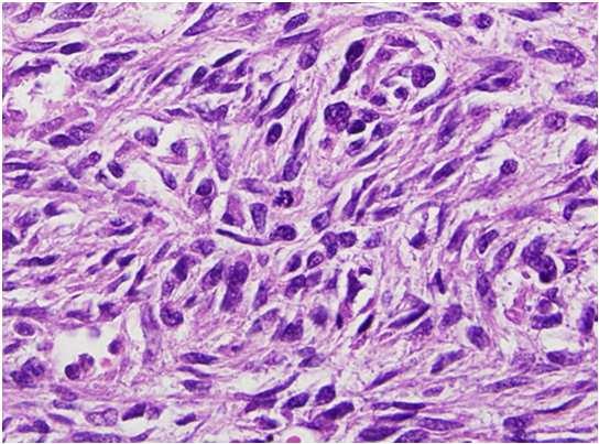 Carcinoma anaplastico Aspetti istologici Cellule fortemente anaplastiche,