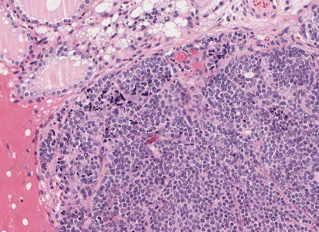 Carcinoma midollare: istologia Cellule poligonali o fusiformi disposte a formare nidi, trabecole o follicoli Possibili piccole cellule in tumori meno differenziati Depositi di amiloide nello stroma