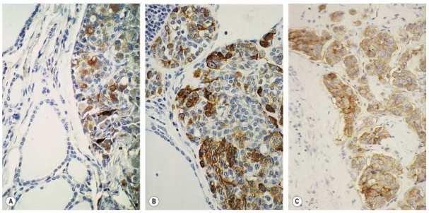 Immunoistochimica Positività marcata per calcitonina A: calcitonina B: cromogranina C: CEA Carcinoma midollare Comportamento clinico Tumore aggressivo con crescita rapida, solitamente i pazienti