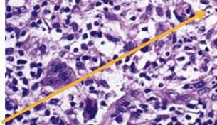 Sindromi da neoplasie multiple neuroendocrine MEN 1 Iperplasia/adenoma delle paratiroidi Tumore secernente della ghiandola pituitaria (solitamente prolattinoma) Tumore neuroendocrino del pancreas