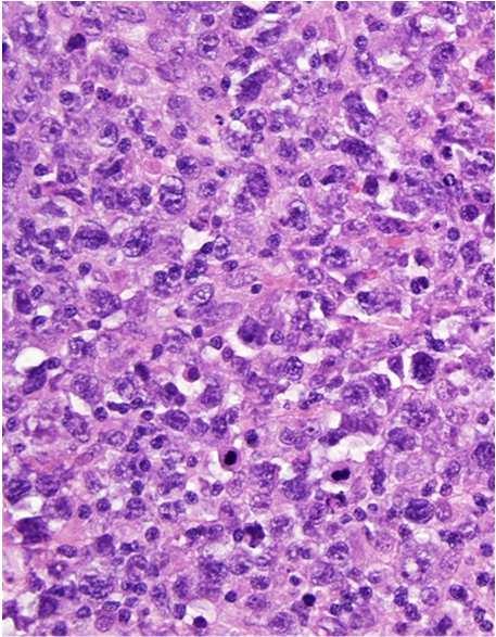 Microscopicamente, il parenchima tiroideo è infiltrato da un tappeto di cellule