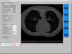 -) CT Polmonare per la diagnosi precoce di cancro al polmone