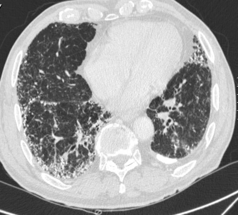 tracheobronchiali, nodulare