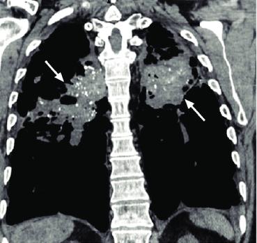 calcificazioni. pseudoplacche pleuriche.