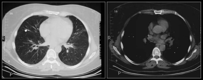 Histoplasma capsulatum Inalazione per