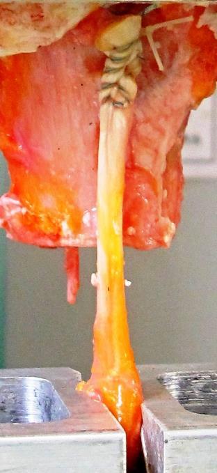 donatore. Si procede con imbastitura del tendine con metodo whip stitch o MFT modificato. Il CLB è tagliato a 1,5 centimetri rispetto al nodo sutura più prossimale.