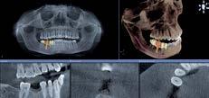 Il progetto protesico digitale > La scansione intraorale pre-chirurgica > Fresaggio del mock-up e adattamento Integrazione del progetto protesico nel volume radiografico 3D > La chirurgia virtuale