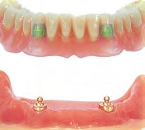 chiavistelli ed abutment per sistemi implantari.