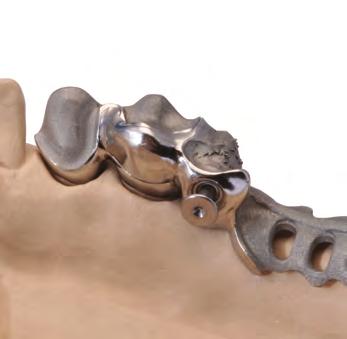 Chiavistelli Sistema chiavistello a scatto Easy-Snap Sistema perfezionato del chiavistello a scatto per un ancoraggio sicuro della protesi.