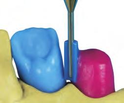Un fresaggio parallelo sulla corona del dente pilastro, abbinato ad un Interlock mesiale o a due coulisse contrapposte ed il corrispondente controfresaggio integrato sulla protesi rimovibile sono i
