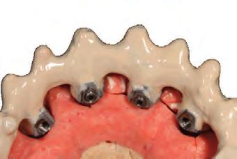 trasversale preconfezionato per il sistema implantare