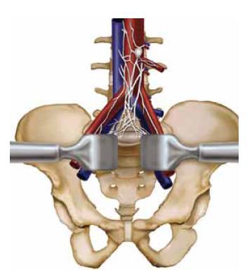 Anterior Lumbar Interbody Fusion ALIF Anterior retroperitoneal or transperitoneal approach to L4-L5 and L5-S1 disc