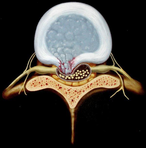 Per Ernia del Disco s intende la