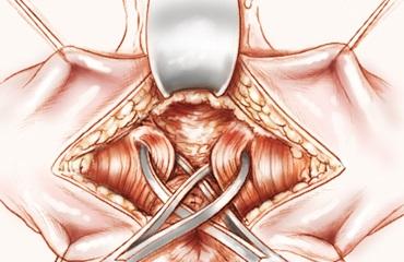 Tecniche Chirurgiche Riparazione sfinteriche anali: Miorrafie