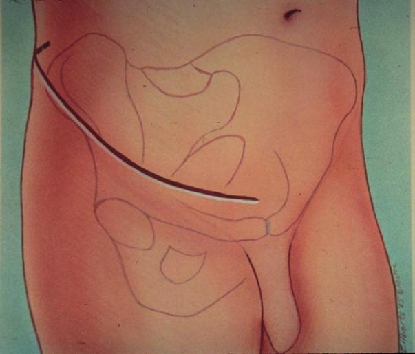 and fixation of posterior column Standard