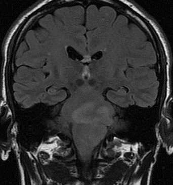 Glioma