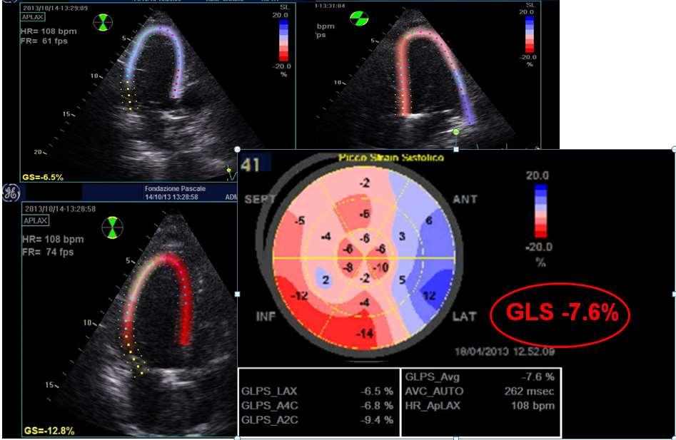 Fig. 16 Donna di 59 anni, sottoposta 20 anni prima a radioterapia mediastinica e chemioterapia con antracicline per