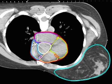 Fig. 1 Contorni delle strutture cardiache in una paziente affetta da cancro della mammella sinistra Structures Il PTV è indicato da una linea continua blu sulla mammella