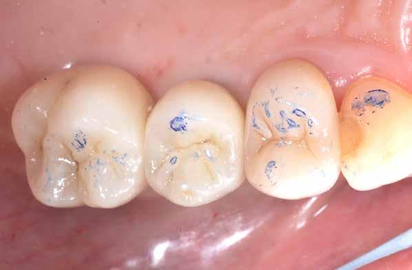 rapidi, ad esempio in casi di problemi alla funzione masticatoria ed estetica compromessa attraverso l'inserimento di impianti post-estrattivi e interventi di