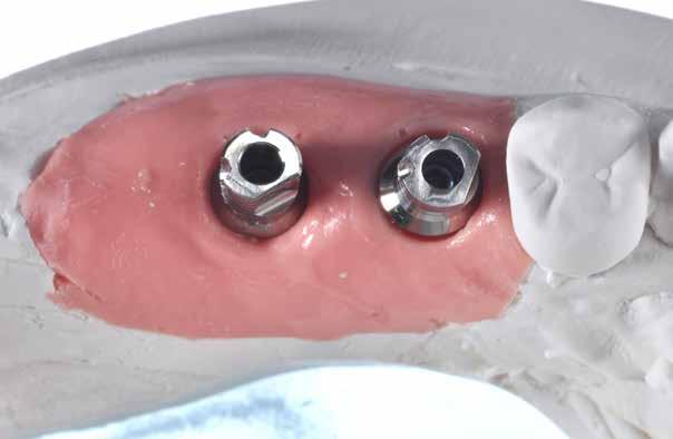 impronta HTLO (Fig. 19) sugli impianti e utilizzando il VPES (Vinyl PolyEther Silicone) GC EXA lence (GC EUROPE, Belgium), (Fig. 20).