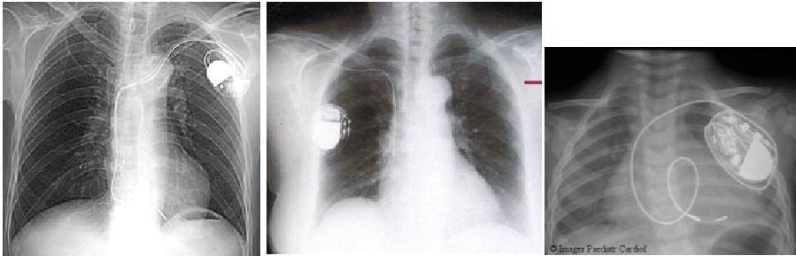 Parametri che giocano un ruolo nel riscaldamento: Area dell impianto Vicinanza dell impianto alla bobina Percorso