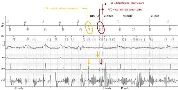 ventricolare, extrasistole ventricolare e fibrillazione ventricolare W1 9 W2 8 7 6 5 4 3 2 1 0 4