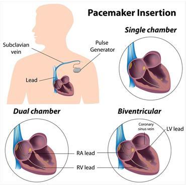 Il pacemaker artificiale Il Pacemaker Artificiale Generatore di impulsi elettrici che raggiungono il cuore e ne provocano la depolarizzazione : eccitazione elettrica del cuore (cattura elettrica) La