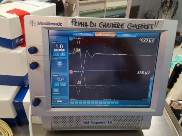 0 msec - Stimolazione S1 (2mA) 1,25-1,50 msec - Stimolazione S2 (2mA) - R1 stimolazione