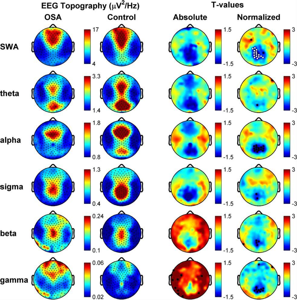 SONNO: Sleep Apnea Scopo: Analisi EEG su pazienti OSA per valutare la funzione neurale durante il sonno.