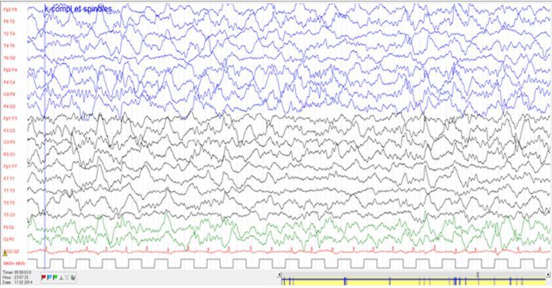 11 year old boy with focal epilepsy. Negative scalp EEG, including sleep recordings using double banana montage from 31 scalp electrodes.