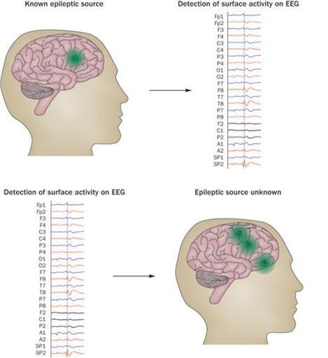 HD-EEG nelle epilessie farmaco-resistenti 2. ESI «The forward problem»: una sorgente epilettica nota produce una distribuzione di attività in superficie.